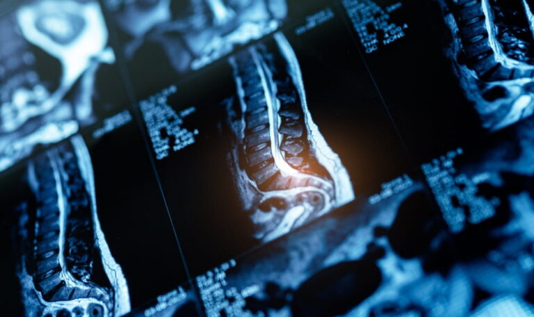 MRI scans showing spinal cord damage and related injuries after a serious accident