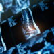 MRI scans showing spinal cord damage and related injuries after a serious accident