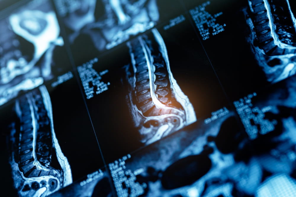 Spinal Cord Injury Diagnostic Imaging MRI scans showing spinal cord damage and related injuries after a serious accident