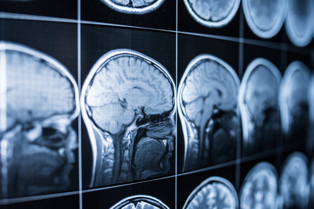 Series of MRI brain scans used to evaluate a traumatic brain injury