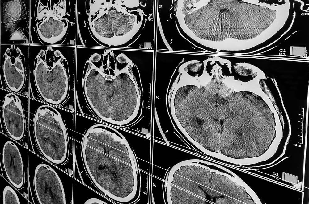 Brain CT scan images often used to evaluate traumatic brain injuries after accidents